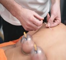 Dry Needling & Cupping